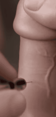 PENIS injectio