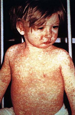 measles child - Winona Journal